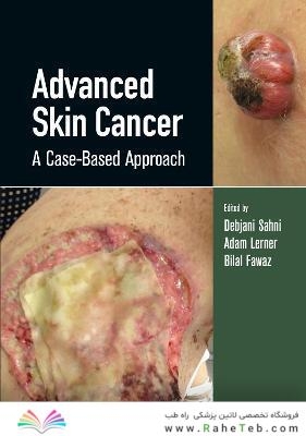 Advanced Skin Cancer: A Case-Based Approach