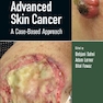 Advanced Skin Cancer: A Case-Based Approach