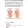 Female Cosmetic Genital Surgery: Concepts, classification and techniques 1st Edition 2017