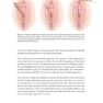 Female Cosmetic Genital Surgery: Concepts, classification and techniques 1st Edition 2017