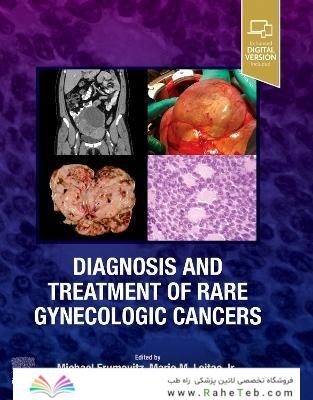 Diagnosis and Treatment of Rare Gynecologic Cancers