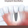 Contemporary Implant Dentistry