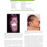 Orthognathic Surgery - 2 Volume Set: Principles and Practice 2nd Edition