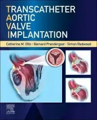 عکس Transcatheter Aortic Valve Implantation