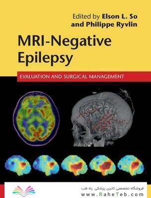 MRI-Negative Epilepsy: Evaluation and Surgical Management