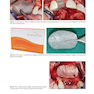 Bone Augmentation in Implant Dentistry: A Step-by-Step Guide to Predictable Alveolar Ridge and Sinus Grafting 1st Edition 2019