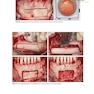Bone Augmentation in Implant Dentistry: A Step-by-Step Guide to Predictable Alveolar Ridge and Sinus Grafting 1st Edition 2019