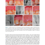  Advances in Periodontal Surgery: A Clinical Guide to Techniques and Interdisciplinary Approaches 1st ed. 2020 Edition پیشرفت در جراحی پریودنتال: راهنمای بالینی تکنیک ها و رویکردهای بین رشته ای