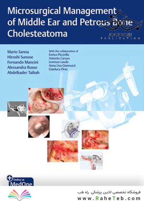 Microsurgical Management of Middle Ear and Petrous Bone Cholesteatoma2019