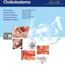 Microsurgical Management of Middle Ear and Petrous Bone Cholesteatoma2019