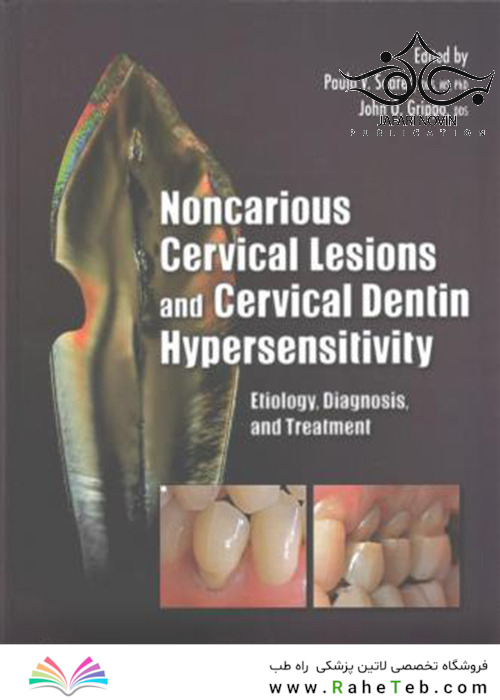 Noncarious Cervical Lesions and Cervical Dentin Hypersensitivity2017 ضایعات غیر سرطانی دهانه رحم و افزایش حساسیت عاج گردنی