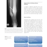 Fracture Reduction and Fixation Techniques: Upper Extremities2018