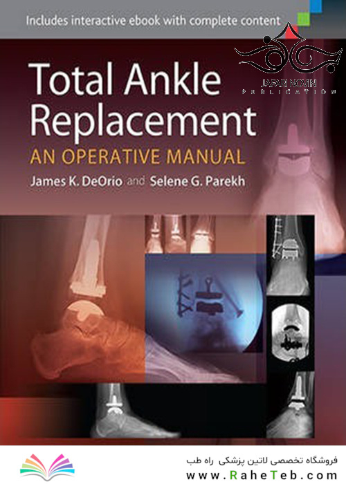 Total Ankle Replacement: An Operative Manual First Edition2014 تعویض کامل مچ پا: یک کتابچه راهنمای عملیاتی