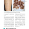 Dermatoscopy and Skin Cancer : A handbook for hunters of skin cancer and melanoma 2019 درماتوسکوپی و سرطان پوست: کتاب راهنما سرطان پوست