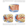Augmentation Mastopexy: Mastering the Art in the Management of the Ptotic