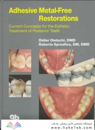 Adhesive Metal-Free Restorations : Current Concepts in the Aesthetic Treatment of Posterior Teeth
