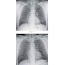 Felson’s PRINCIPLES OF CHEST ROENTGENOLOGY