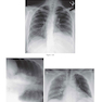 Felson’s PRINCIPLES OF CHEST ROENTGENOLOGY