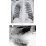 Felson’s PRINCIPLES OF CHEST ROENTGENOLOGY