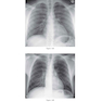 Felson’s PRINCIPLES OF CHEST ROENTGENOLOGY