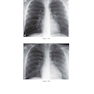 Felson’s PRINCIPLES OF CHEST ROENTGENOLOGY