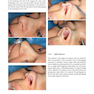 Aesthetic Septorhinoplasty 2021