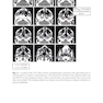Target Volume Delineation and Field Setup : A Practical Guide for Conformal and Intensity-Modulated Radiation Therapy