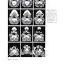 Target Volume Delineation and Field Setup : A Practical Guide for Conformal and Intensity-Modulated Radiation Therapy