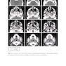 Target Volume Delineation and Field Setup : A Practical Guide for Conformal and Intensity-Modulated Radiation Therapy