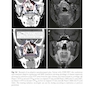 Target Volume Delineation and Field Setup : A Practical Guide for Conformal and Intensity-Modulated Radiation Therapy