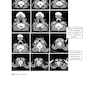 Target Volume Delineation and Field Setup : A Practical Guide for Conformal and Intensity-Modulated Radiation Therapy