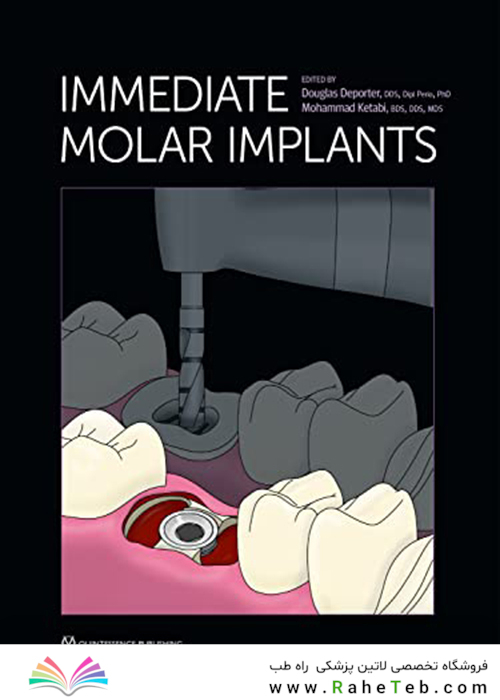 Immediate Molar Implants Kindle Edition