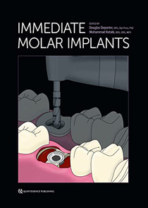 عکس Immediate Molar Implants Kindle Edition