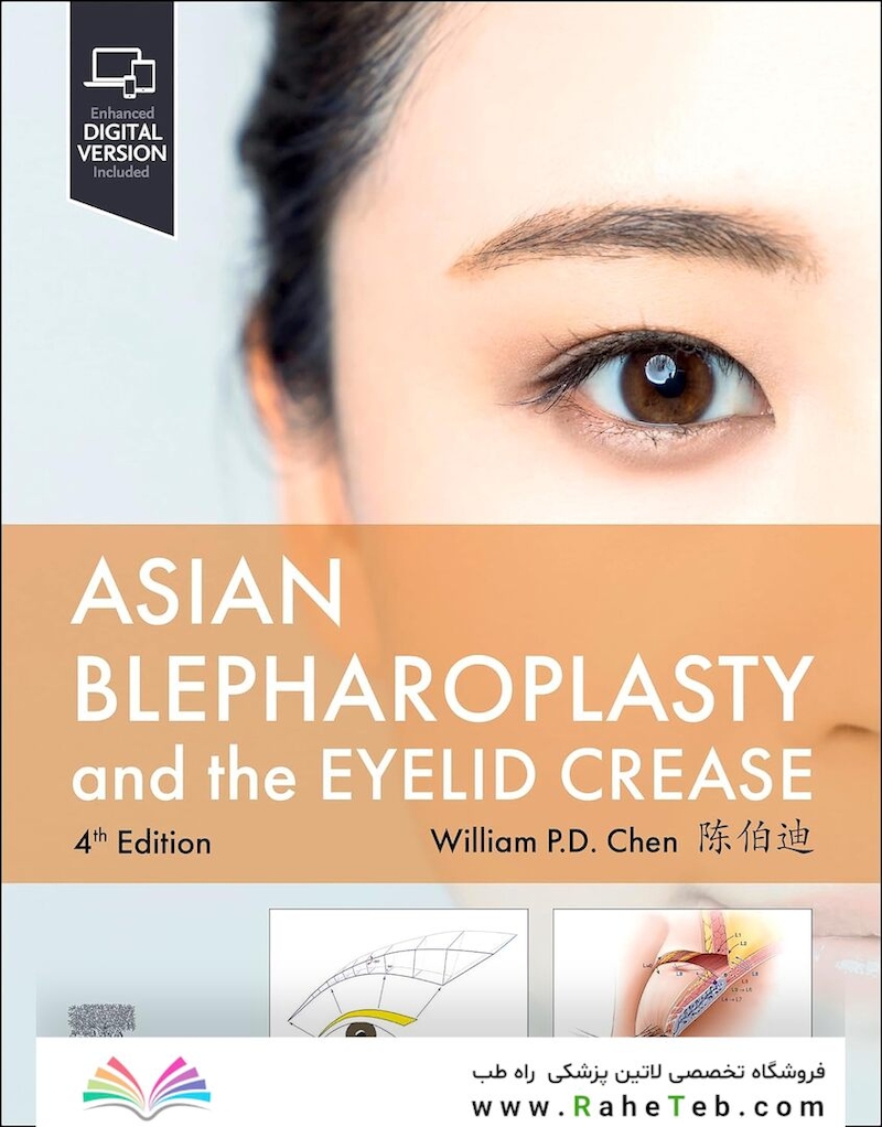 Asian Blepharoplasty and the Eyelid Crease  4th Edition
