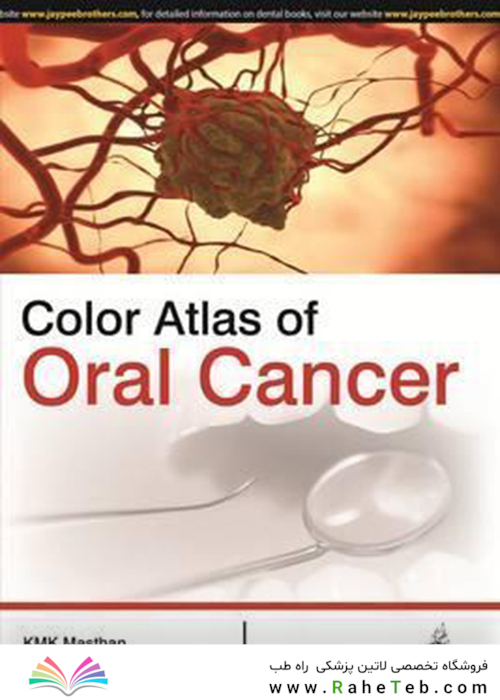 Color Atlas of Oral Cancer
