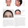 Advances in Hyaluronic Acid Filler Injections
