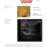 Advances in Hyaluronic Acid Filler Injections