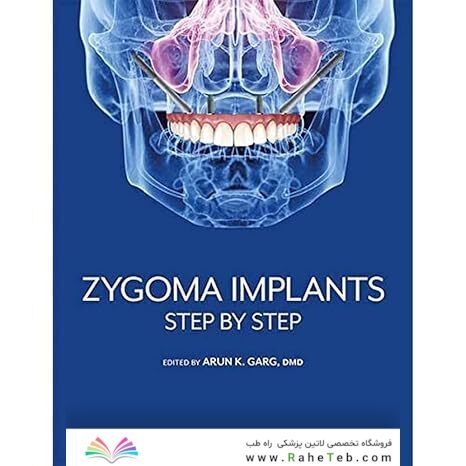 Zygoma Implants: Step by Step 1st Edition
