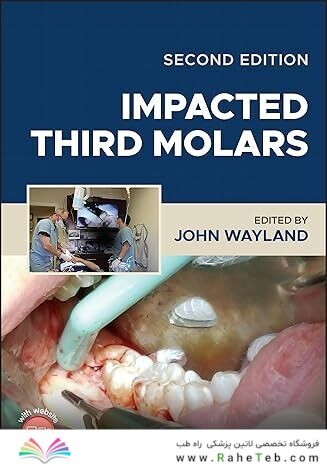 Impacted Third Molars 2nd Edition