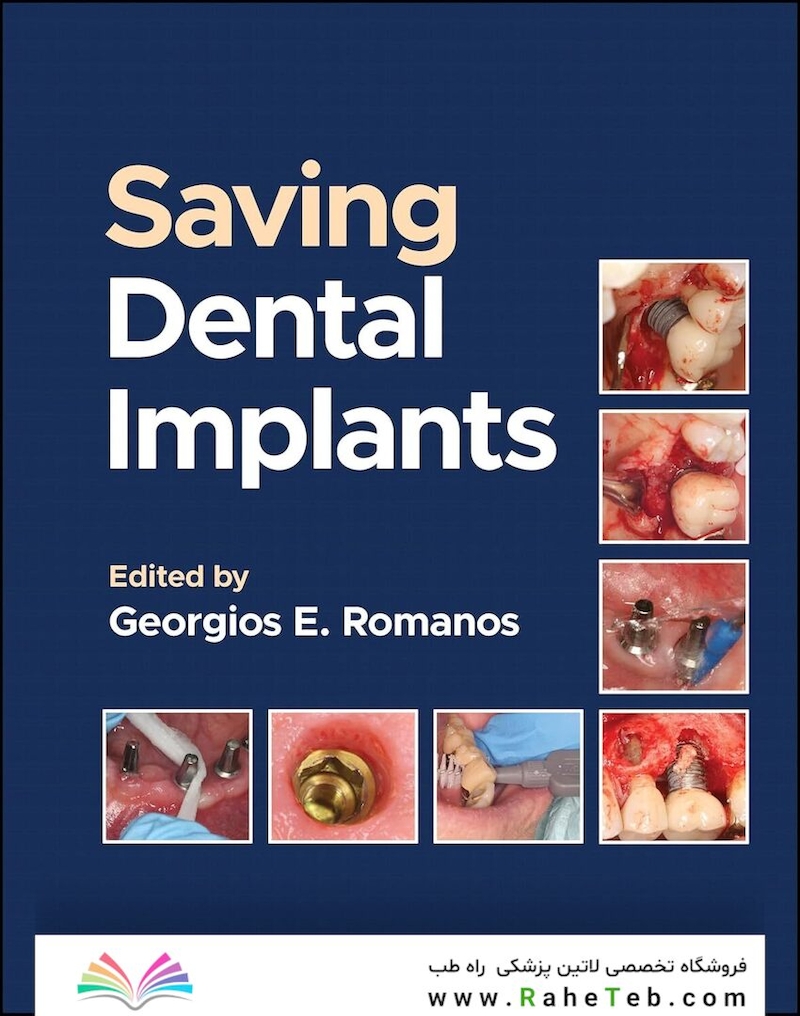 Saving Dental Implants 1st Edition