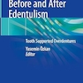 Treatment Options Before and After Edentulism: Tooth Supported Overdentures 1st ed