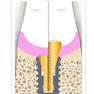 Implant Prosthodontics: Protocols and Techniques for Fixed Implant Restorations