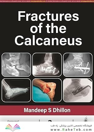 Fractures of the Calcaneus