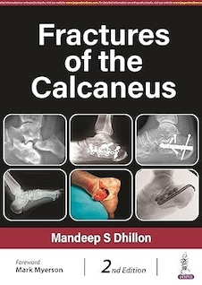 عکس Fractures of the Calcaneus