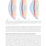 2024-2025 Basic and Clinical Science Course, Section 13: Refractive Surgery