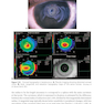 2024-2025 Basic and Clinical Science Course, Section 13: Refractive Surgery