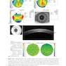 2024-2025 Basic and Clinical Science Course, Section 13: Refractive Surgery