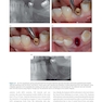 Immediate Dental Implants for Esthetic and Premolar Sites 1st Edition