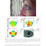 2025-2026 Basic and Clinical Science Course, Section 13: Refractive Surgery