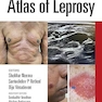 Atlas of Leprosy 1st Edition